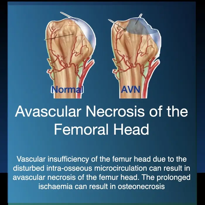 Hyperbaric oxygen therapy for avascular necrosis of bone