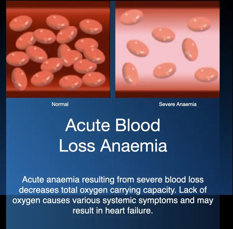 Hyperbaric oxygen therapy for severe blood-loss anaemia
