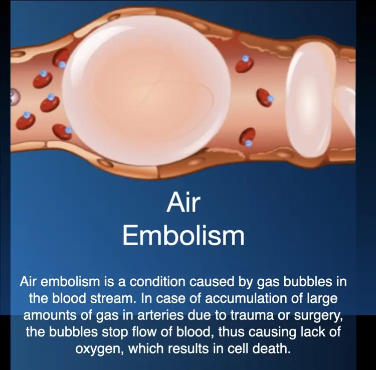 Hyperbaric oxygen therapy for air or gas embolism