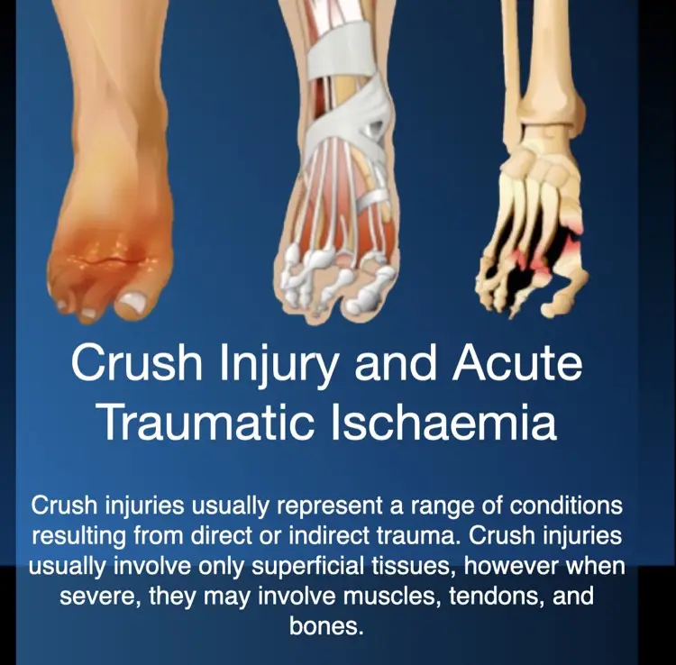 Hyperbaric oxygen therapy for crush injury and acute traumatic ischaemia