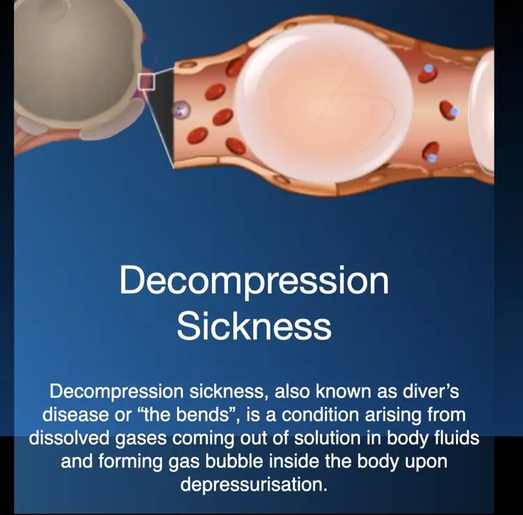 Hyperbaric oxygen therapy for decompression sickness