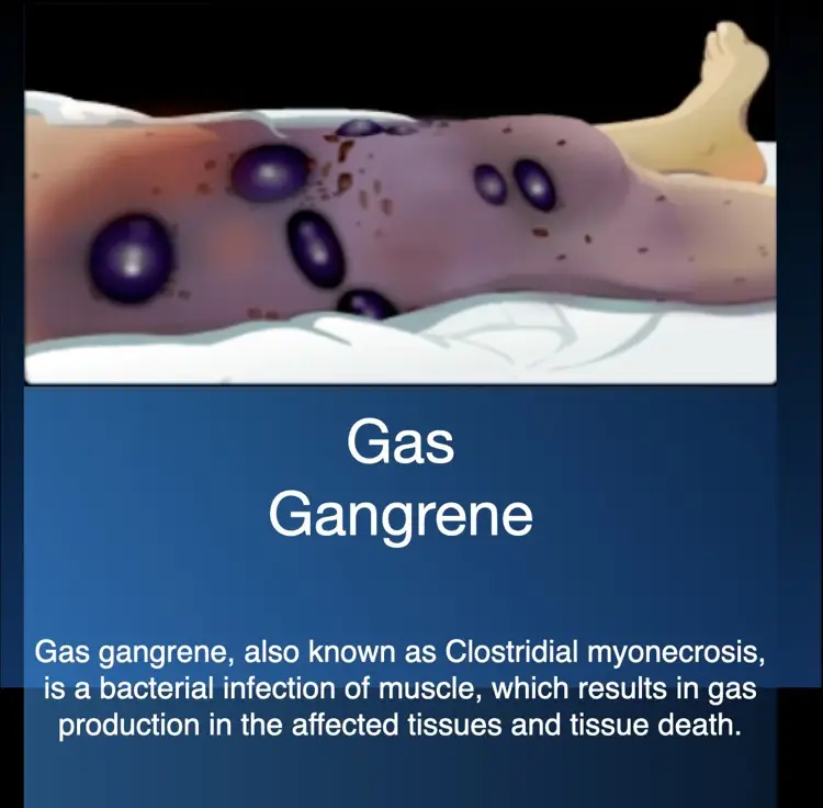 Hyperbaric oxygen therapy for gas gangrene