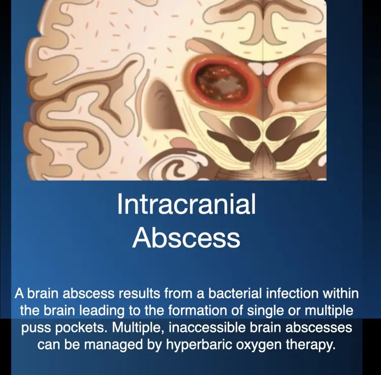 Hyperbaric oxygen therapy for intracranial brain abscess