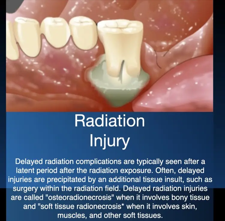 Hyperbaric oxygen therapy for late radiation injury and osteoradionecrosis