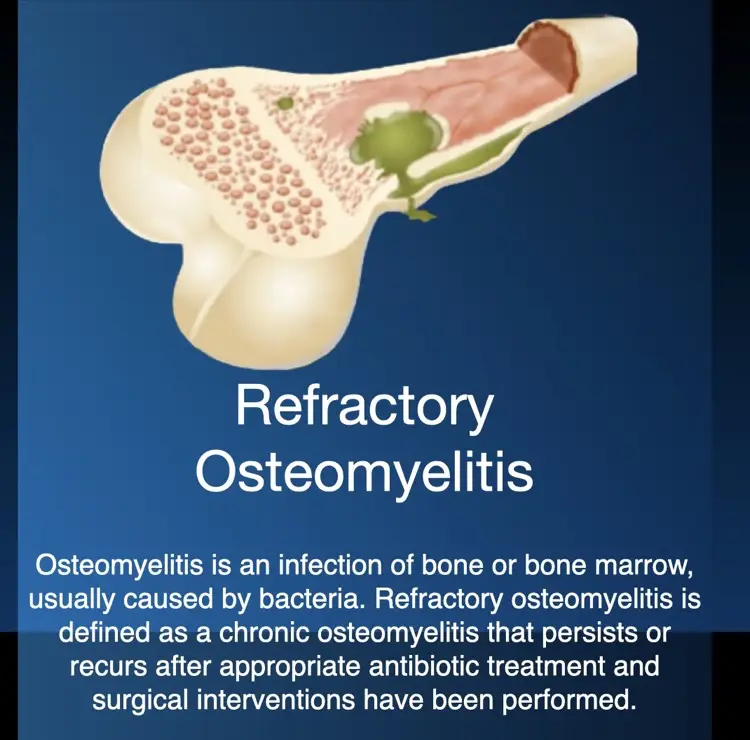 Hyperbaric oxygen therapy for refractory osteomyelitis