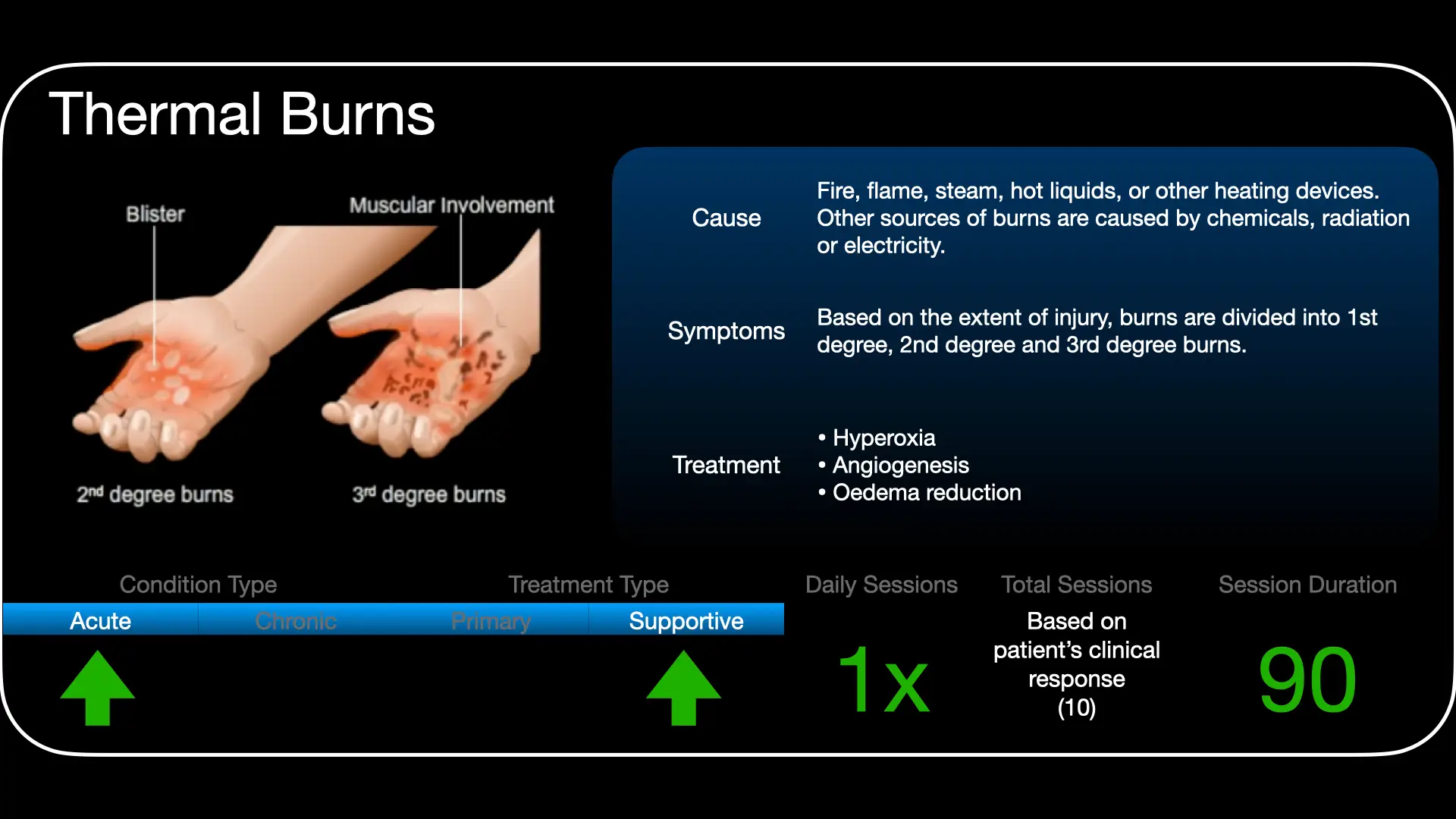 Treatment approach for hyperbaric oxygen therapy in acute thermal burns