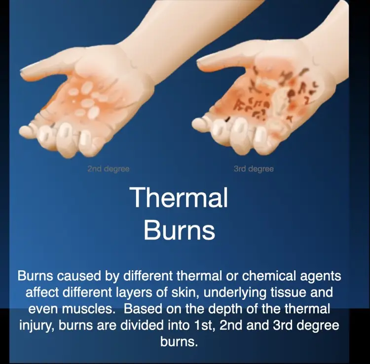 Hyperbaric oxygen therapy for acute thermal burns