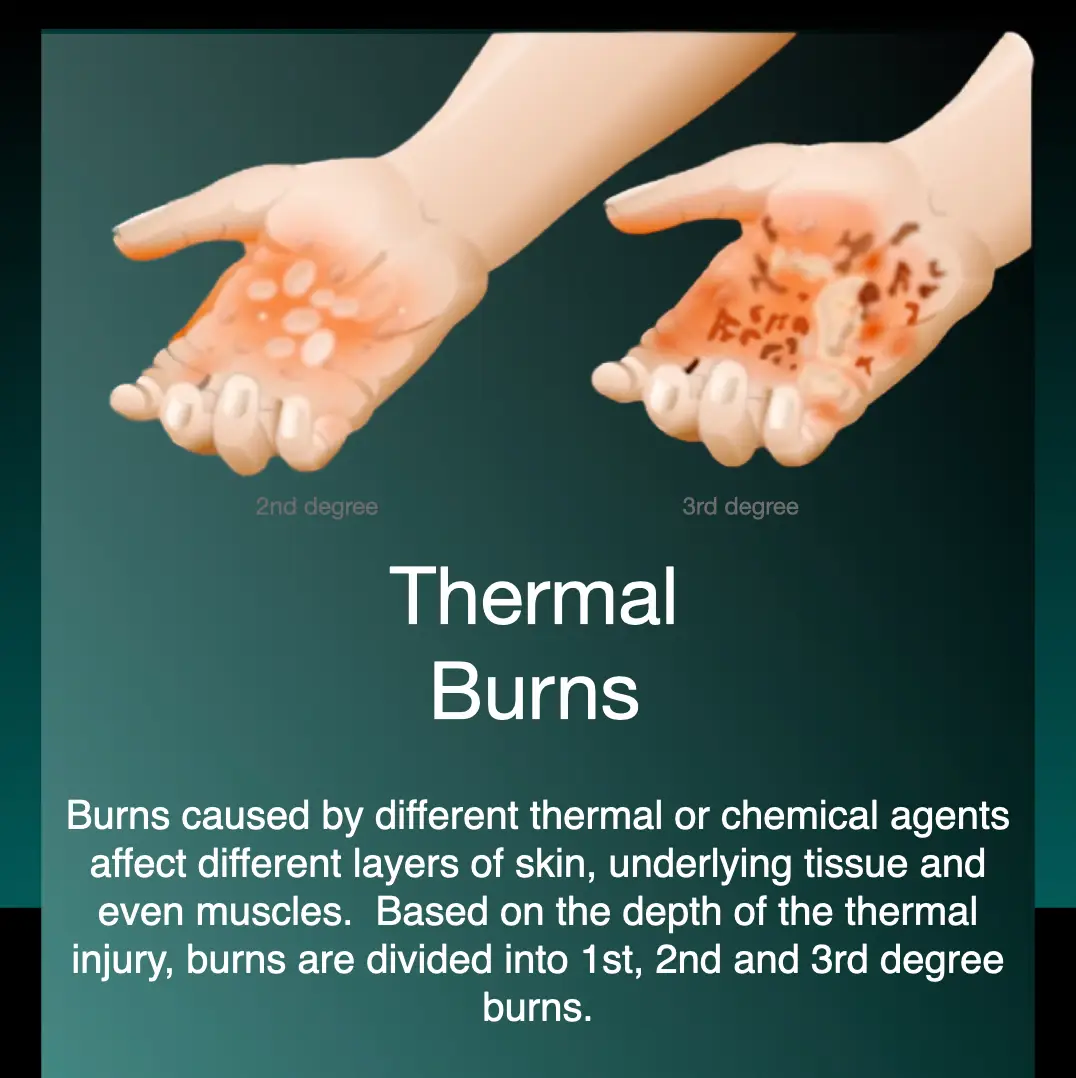 Infographic on how hyperbaric oxygen supports modern burn care
